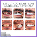 ProSmile NaturalFit™ — Faceta Dentária Ajustável