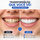 ProSmile NaturalFit™ - Faceta Dentária Ajustável